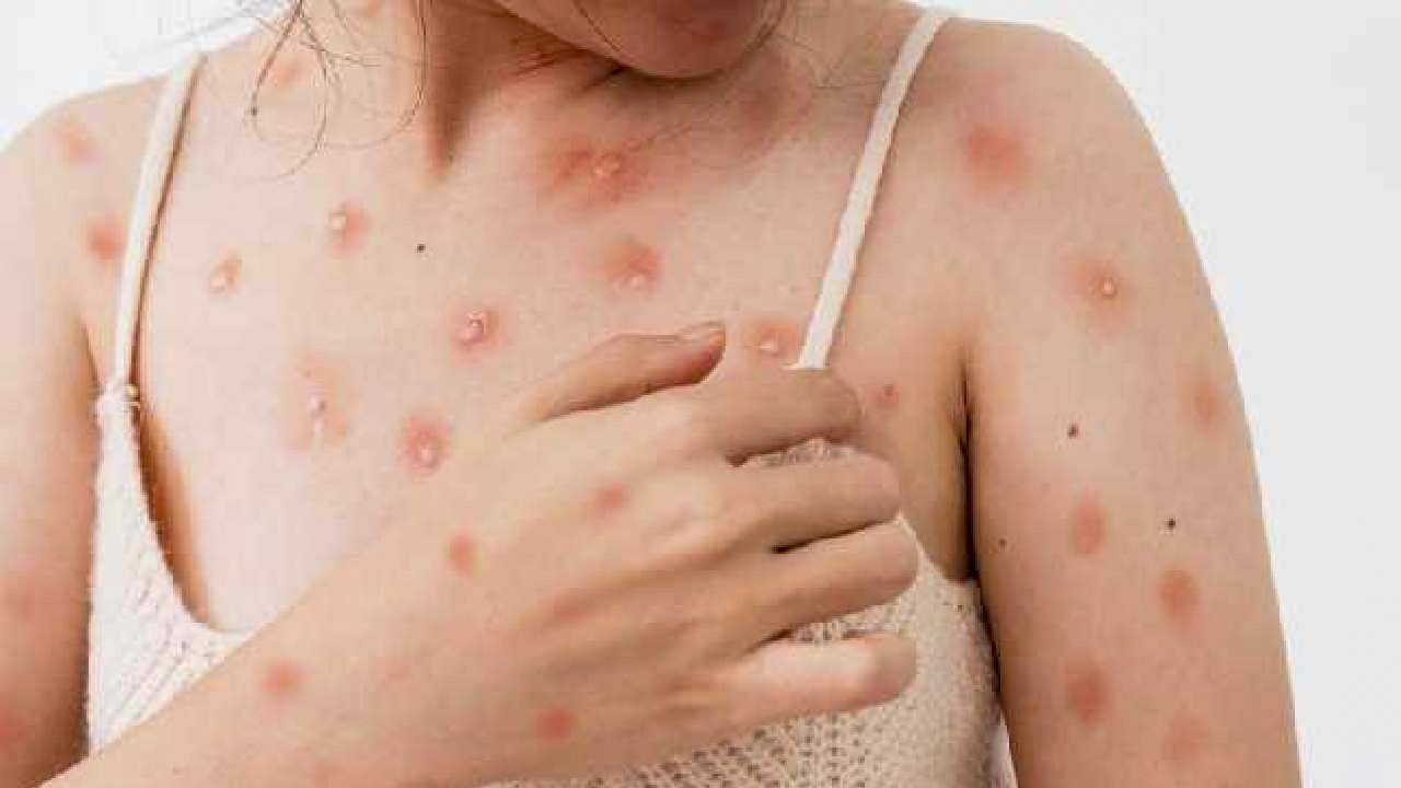 SE HAN REGISTRADO 49 CASOS DE VIRUELA DEL MONO EN YUCATÁN